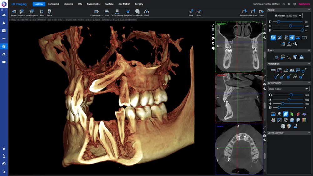 Vy av 3D-modulen i Planmeca Romexis