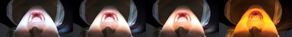 Fyra olika f&auml;rgl&auml;gen f&ouml;r Planmeca Solanna operationsbelysning