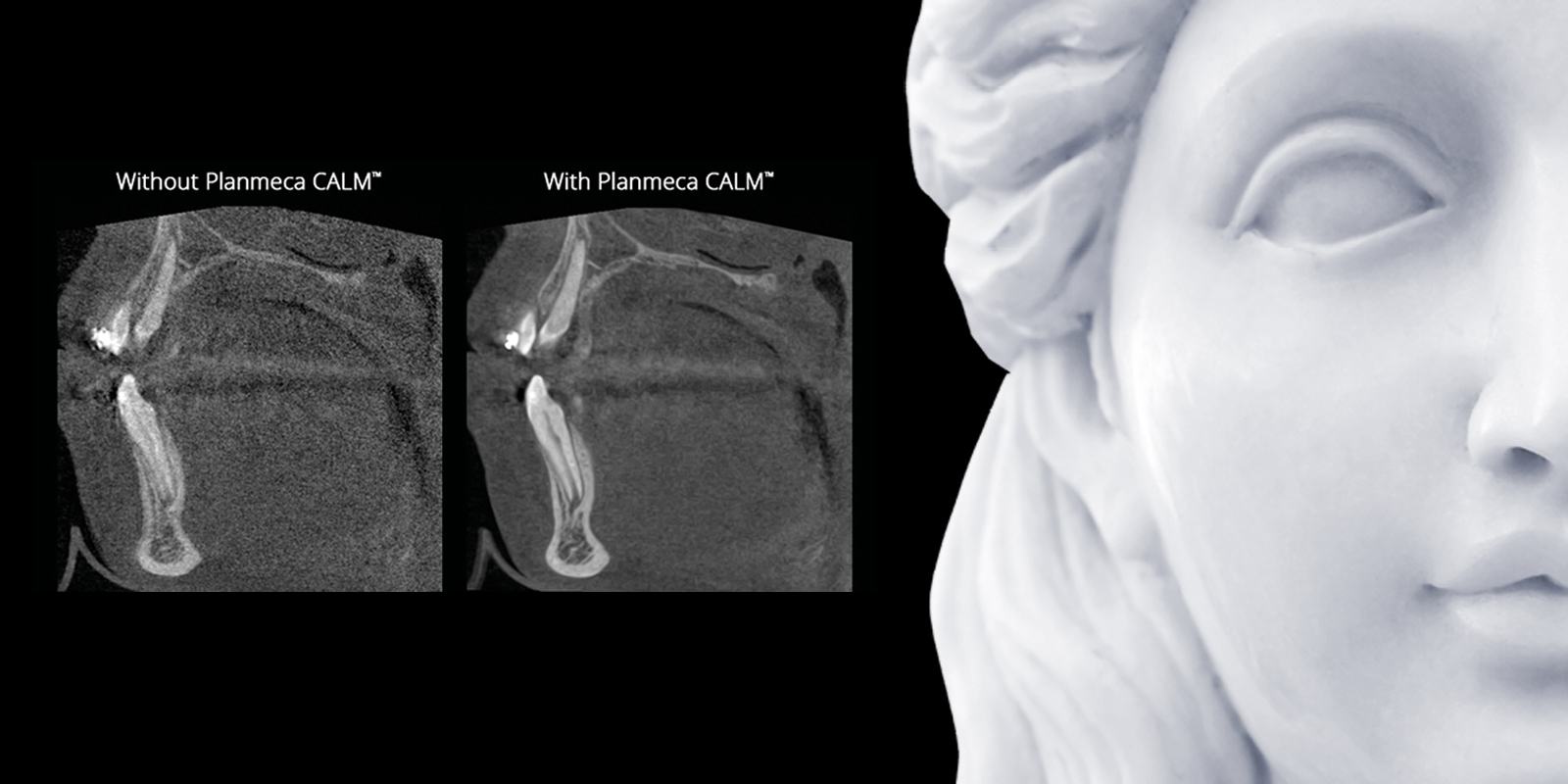 Exempelbild som visar med och utan anv&auml;ndningen av Planmeca Calm