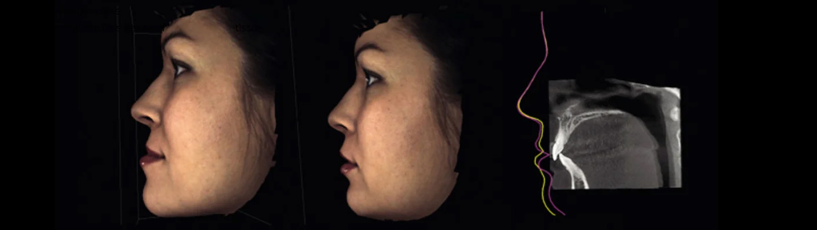 ProFace ansiktsfoto f&ouml;re och efter en operation